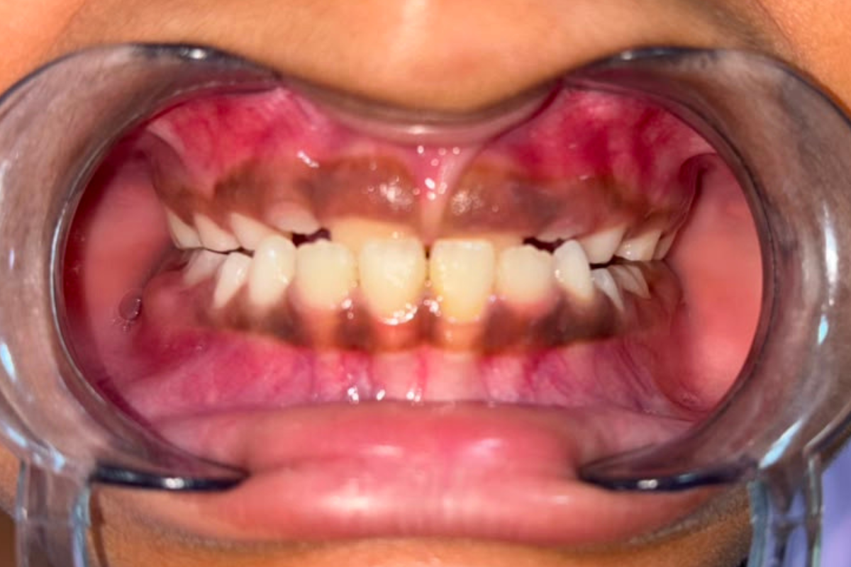 After Treatment